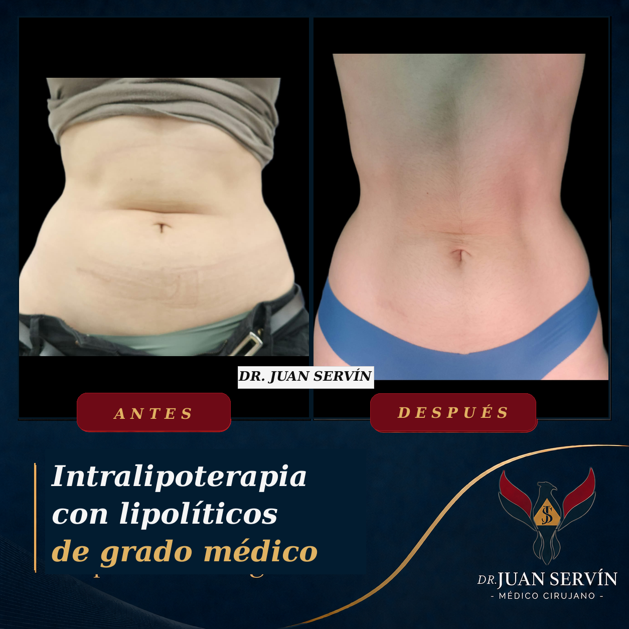Resultado antes y después · intralipoterapia
